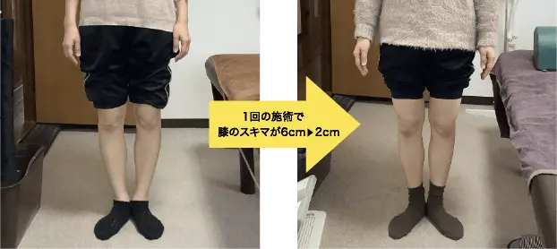 1回の施術で膝のスキマが6cm ▶ 2cm