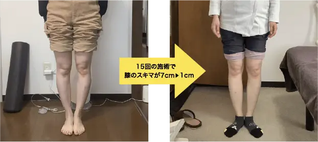 15回の施術で膝のスキマが7cm ▶ 1cm