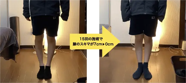15回の施術で膝のスキマが7cm ▶ 0cm